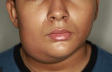 Gondongan: Penyebab, Gejala & Pengobatannya