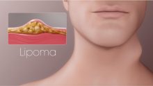 Tips Sembuhkan Lipoma Tanpa Operasi