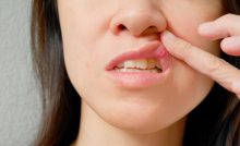 Air Kelapa Dapat Meredakan Sariawan